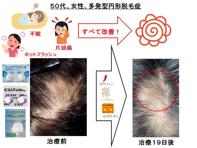 円形脱毛症　病院